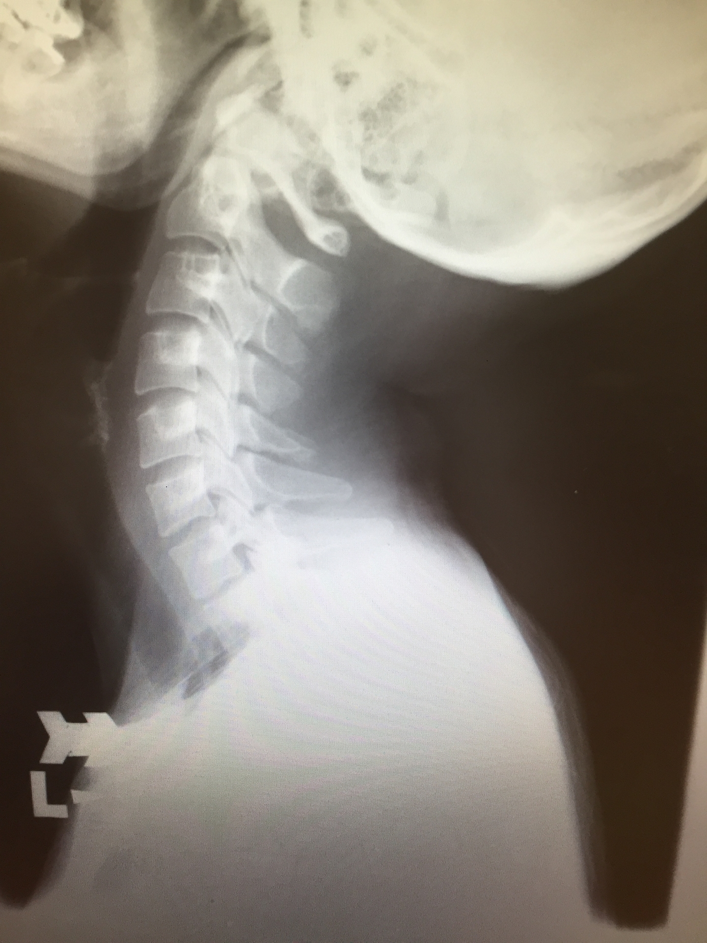 レントゲン写真