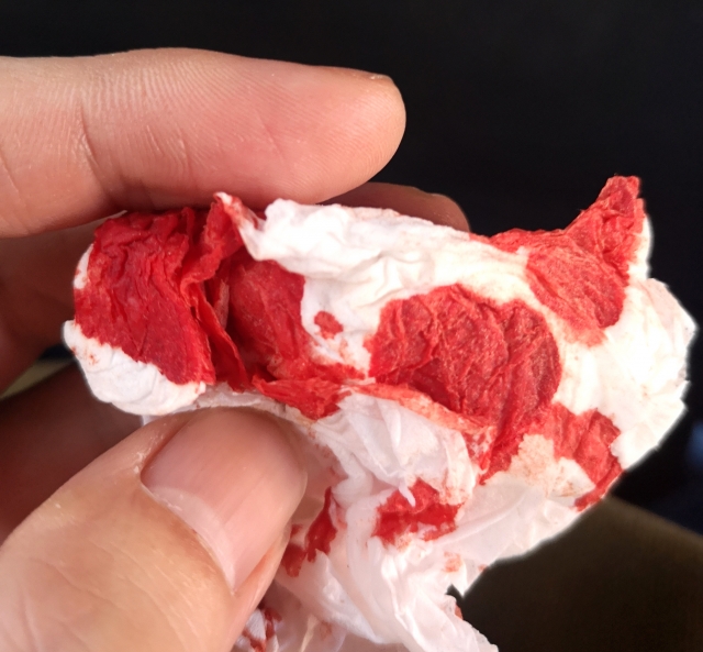 たんに血が混じる（血痰）