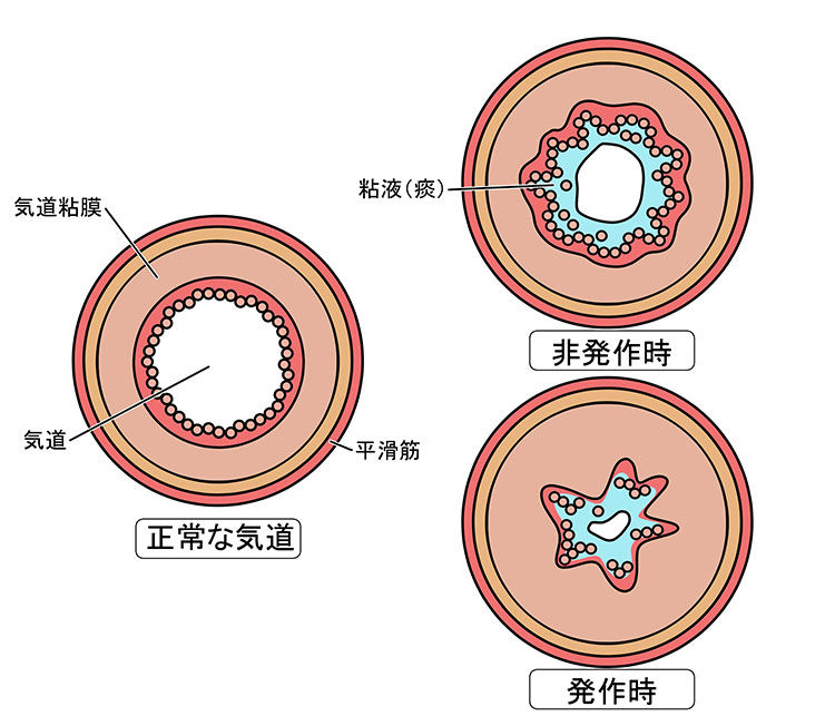 呼吸がゼーゼーする